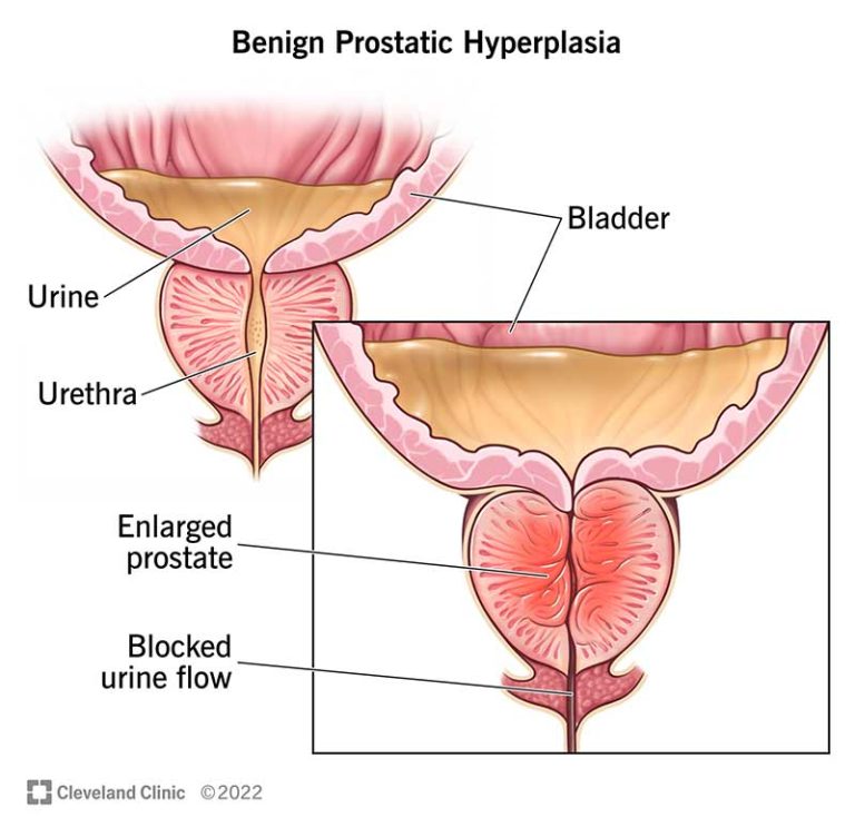Prostate Enlargement and Prostate Cancer